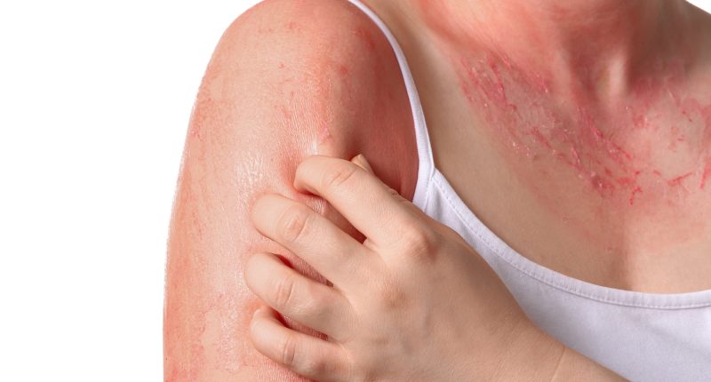 Atopický ekzém / Atopická dermatitida / Depositphotos